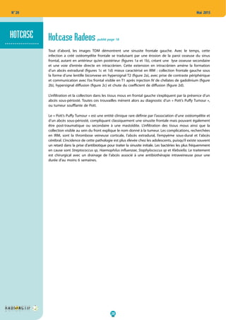 20
N° 20 Mai 2015
Hotcase Radeos publié page 18
Tout d’abord, les images TDM démontrent une sinusite frontale gauche. Avec le temps, cette
infection a créé ostéomyélite frontale se traduisant par une érosion de la paroi osseuse du sinus
frontal, autant en antérieur qu’en postérieur (figures 1a et 1b), créant une lyse osseuse secondaire
et une voie d’entrée directe en intracrânien. Cette extension en intracrânien amène la formation
d’un abcès extradural (figures 1c et 1d) mieux caractérisé en IRM  : collection frontale gauche sous
la forme d’une lentille biconvexe en hypersignal T2 (figure 2a), avec prise de contraste périphérique
et communication avec l’os frontal visible en T1 après injection IV de chélates de gadolinium (figure
2b), hypersignal diffusion (figure 2c) et chute du coefficient de diffusion (figure 2d).
L’infiltration et la collection dans les tissus mous en frontal gauche s’expliquent par la présence d’un
abcès sous-périosté. Toutes ces trouvailles mènent alors au diagnostic d’un « Pott’s Puffy Tumour »,
ou tumeur soufflante de Pott.
Le « Pott’s Puffy Tumour » est une entité clinique rare définie par l’association d’une ostéomyélite et
d’un abcès sous-périosté, compliquant classiquement une sinusite frontale mais pouvant également
être post-traumatique ou secondaire à une mastoïdite. L’infiltration des tissus mous ainsi que la
collection visible au sein du front explique le nom donné à la tumeur. Les complications, recherchées
en IRM, sont la thrombose veineuse corticale, l’abcès extradural, l’empyème sous-dural et l’abcès
cérébral. L’incidence de cette pathologie est plus élevée chez les adolescents, puisqu’il existe souvent
un retard dans la prise d’antibiotique pour traiter la sinusite initiale. Les bactéries les plus fréquemment
en cause sont Streptococcus sp, Haemophilus influenzae, Staphylococcus sp et Klebsiella. Le traitement
est chirurgical avec un drainage de l’abcès associé à une antibiothérapie intraveineuse pour une
durée d’au moins 6 semaines.
.................
HOTCASE
 