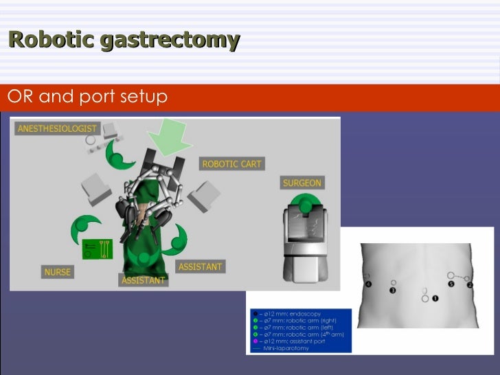 Robotic Gastrectomy for Gastric Cancer a European Experience