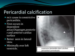 Pericardial calcification
 m/c cause is constrictive

pericarditis.
 First occurs in
dependent
areas:Diapragm,posterio
r and anterior cardiac
surface
 Better seen in lateral
view.
 Minimally over left
ventricle.

 