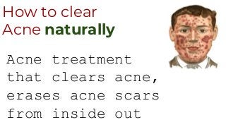 How to clear
Acne naturally
Acne treatment
that clears acne,
erases acne scars
from inside out
 