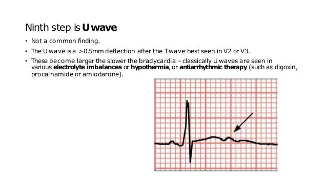 Ninth step isUwave
• Not a common finding.
• The U wave is a >0.5mm deflection after the Twave best seen in V2 or V3.
• These become larger the slower the bradycardia – classically U waves are seen in
various electrolyte imbalances or hypothermia, or antiarrhythmic therapy (such as digoxin,
procainamide or amiodarone).
 
