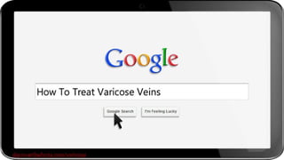 How to Treat Varicose Veins