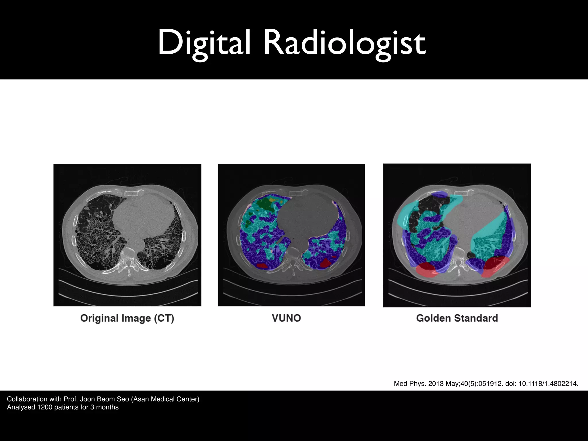 Digital Radiologist
Med Phys. 2013 May;40(5):051912. doi: 10.1118/1.4802214.
Collaboration with Prof. Joon Beom Seo (Asan Medical Center)
Analysed 1200 patients for 3 months
 