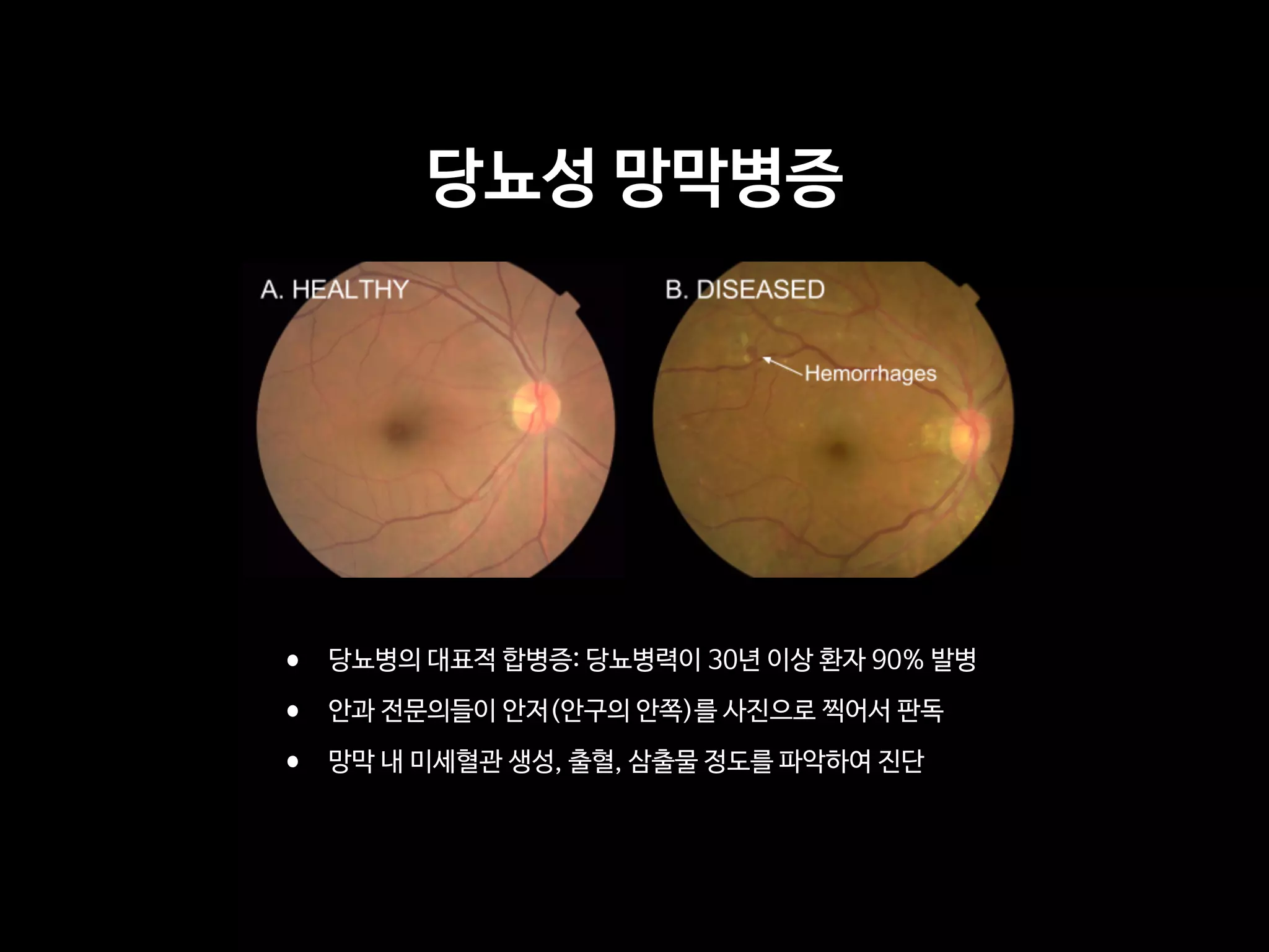 당뇨성 망막병증
• 당뇨병의 대표적 합병증: 당뇨병력이 30년 이상 환자 90% 발병

• 안과 전문의들이 안저(안구의 안쪽)를 사진으로 찍어서 판독

• 망막 내 미세혈관 생성, 출혈, 삼출물 정도를 파악하여 진단
 
