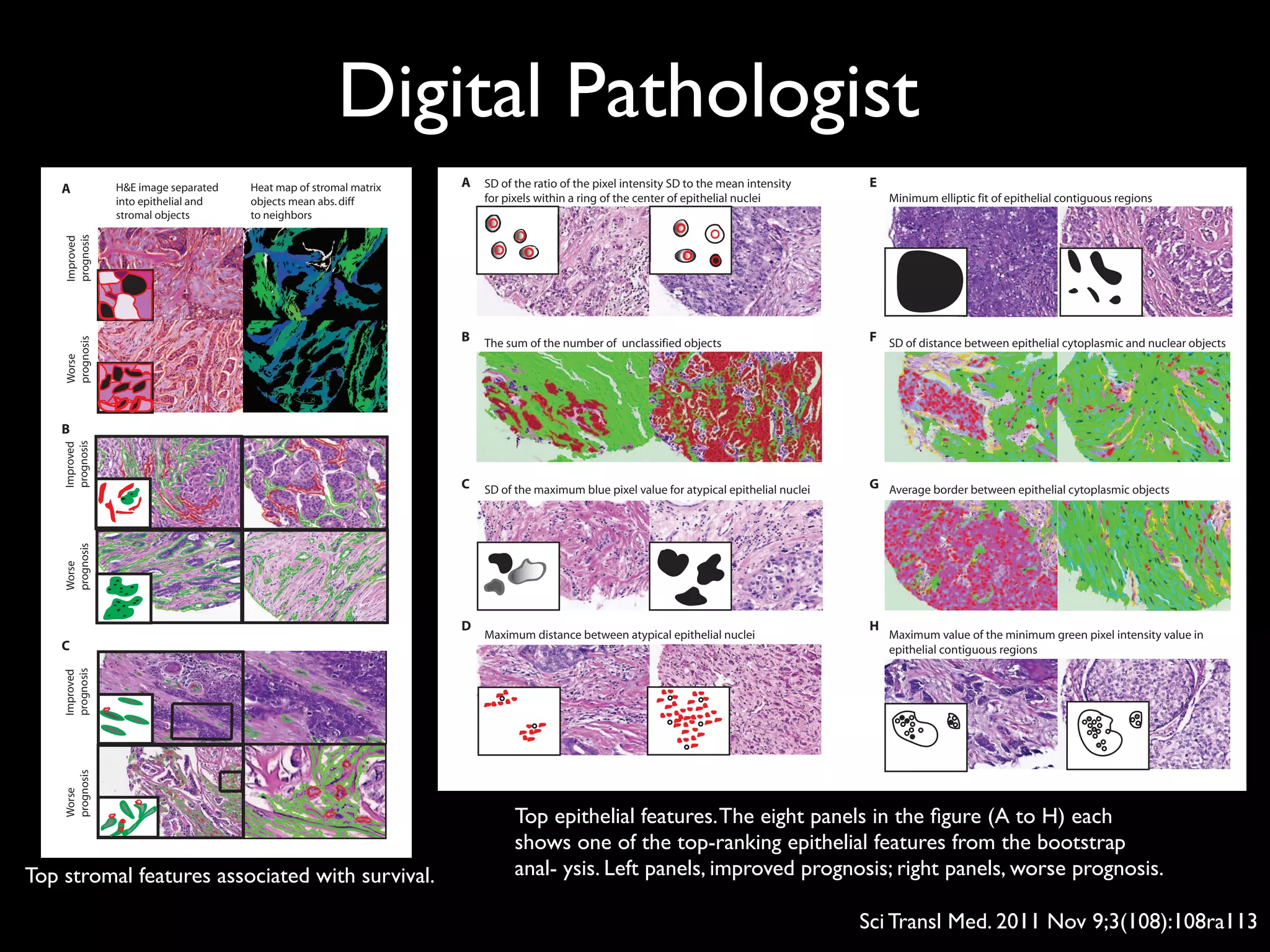 Digital Pathologist
Sci Transl Med. 2011 Nov 9;3(108):108ra113
Top stromal features associated with survival.
primarily characterizing epithelial nuclear characteristics, such as
size, color, and texture (21, 36). In contrast, after initial filtering of im-
ages to ensure high-quality TMA images and training of the C-Path
models using expert-derived image annotations (epithelium and
stroma labels to build the epithelial-stromal classifier and survival
time and survival status to build the prognostic model), our image
analysis system is automated with no manual steps, which greatly in-
creases its scalability. Additionally, in contrast to previous approaches,
our system measures thousands of morphologic descriptors of diverse
identification of prognostic features whose significance was not pre-
viously recognized.
Using our system, we built an image-based prognostic model on
the NKI data set and showed that in this patient cohort the model
was a strong predictor of survival and provided significant additional
prognostic information to clinical, molecular, and pathological prog-
nostic factors in a multivariate model. We also demonstrated that the
image-based prognostic model, built using the NKI data set, is a strong
prognostic factor on another, independent data set with very different
SD of the ratio of the pixel intensity SD to the mean intensity
for pixels within a ring of the center of epithelial nuclei
A
The sum of the number of unclassified objects
SD of the maximum blue pixel value for atypical epithelial nuclei
Maximum distance between atypical epithelial nuclei
B
C
D
Maximum value of the minimum green pixel intensity value in
epithelial contiguous regions
Minimum elliptic fit of epithelial contiguous regions
SD of distance between epithelial cytoplasmic and nuclear objects
Average border between epithelial cytoplasmic objects
E
F
G
H
Fig. 5. Top epithelial features. The eight panels in the figure (A to H) each
shows one of the top-ranking epithelial features from the bootstrap anal-
ysis. Left panels, improved prognosis; right panels, worse prognosis. (A) SD
of the (SD of intensity/mean intensity) for pixels within a ring of the center
of epithelial nuclei. Left, relatively consistent nuclear intensity pattern (low
score); right, great nuclear intensity diversity (high score). (B) Sum of the
number of unclassified objects. Red, epithelial regions; green, stromal re-
gions; no overlaid color, unclassified region. Left, few unclassified objects
(low score); right, higher number of unclassified objects (high score). (C) SD
of the maximum blue pixel value for atypical epithelial nuclei. Left, high
score; right, low score. (D) Maximum distance between atypical epithe-
lial nuclei. Left, high score; right, low score. (Insets) Red, atypical epithelial
nuclei; black, typical epithelial nuclei. (E) Minimum elliptic fit of epithelial
contiguous regions. Left, high score; right, low score. (F) SD of distance
between epithelial cytoplasmic and nuclear objects. Left, high score; right,
low score. (G) Average border between epithelial cytoplasmic objects. Left,
high score; right, low score. (H) Maximum value of the minimum green
pixel intensity value in epithelial contiguous regions. Left, low score indi-
cating black pixels within epithelial region; right, higher score indicating
presence of epithelial regions lacking black pixels.
onNovember17,2011stm.sciencemag.orgDownloadedfrom
and stromal matrix throughout the image, with thin cords of epithe-
lial cells infiltrating through stroma across the image, so that each
stromal matrix region borders a relatively constant proportion of ep-
ithelial and stromal regions. The stromal feature with the second
largest coefficient (Fig. 4B) was the sum of the minimum green in-
tensity value of stromal-contiguous regions. This feature received a
value of zero when stromal regions contained dark pixels (such as
inflammatory nuclei). The feature received a positive value when
stromal objects were devoid of dark pixels. This feature provided in-
formation about the relationship between stromal cellular composi-
tion and prognosis and suggested that the presence of inflammatory
cells in the stroma is associated with poor prognosis, a finding con-
sistent with previous observations (32). The third most significant
stromal feature (Fig. 4C) was a measure of the relative border between
spindled stromal nuclei to round stromal nuclei, with an increased rel-
ative border of spindled stromal nuclei to round stromal nuclei asso-
ciated with worse overall survival. Although the biological underpinning
of this morphologic feature is currently not known, this analysis sug-
gested that spatial relationships between different populations of stro-
mal cell types are associated with breast cancer progression.
Reproducibility of C-Path 5YS model predictions on
samples with multiple TMA cores
For the C-Path 5YS model (which was trained on the full NKI data
set), we assessed the intrapatient agreement of model predictions when
predictions were made separately on each image contributed by pa-
tients in the VGH data set. For the 190 VGH patients who contributed
two images with complete image data, the binary predictions (high
or low risk) on the individual images agreed with each other for 69%
(131 of 190) of the cases and agreed with the prediction on the aver-
aged data for 84% (319 of 380) of the images. Using the continuous
prediction score (which ranged from 0 to 100), the median of the ab-
solute difference in prediction score among the patients with replicate
images was 5%, and the Spearman correlation among replicates was
0.27 (P = 0.0002) (fig. S3). This degree of intrapatient agreement is
only moderate, and these findings suggest significant intrapatient tumor
heterogeneity, which is a cardinal feature of breast carcinomas (33–35).
Qualitative visual inspection of images receiving discordant scores
suggested that intrapatient variability in both the epithelial and the
stromal components is likely to contribute to discordant scores for
the individual images. These differences appeared to relate both to
the proportions of the epithelium and stroma and to the appearance
of the epithelium and stroma. Last, we sought to analyze whether sur-
vival predictions were more accurate on the VGH cases that contributed
multiple cores compared to the cases that contributed only a single
core. This analysis showed that the C-Path 5YS model showed signif-
icantly improved prognostic prediction accuracy on the VGH cases
for which we had multiple images compared to the cases that con-
tributed only a single image (Fig. 7). Together, these findings show
a significant degree of intrapatient variability and indicate that increased
tumor sampling is associated with improved model performance.
DISCUSSION
Heat map of stromal matrix
objects mean abs.diff
to neighbors
H&E image separated
into epithelial and
stromal objects
A
B
C
Worse
prognosis
Improved
prognosis
Improved
prognosis
Improved
prognosis
Worse
prognosis
Worse
prognosis
Fig. 4. Top stromal features associated with survival. (A) Variability in ab-
solute difference in intensity between stromal matrix regions and neigh-
bors. Top panel, high score (24.1); bottom panel, low score (10.5). (Insets)
Top panel, high score; bottom panel; low score. Right panels, stromal matrix
objects colored blue (low), green (medium), or white (high) according to
each object’s absolute difference in intensity to neighbors. (B) Presence
R E S E A R C H A R T I C L E
onNovember17,2011stm.sciencemag.orgDownloadedfrom
Top epithelial features.The eight panels in the ﬁgure (A to H) each
shows one of the top-ranking epithelial features from the bootstrap
anal- ysis. Left panels, improved prognosis; right panels, worse prognosis.
 