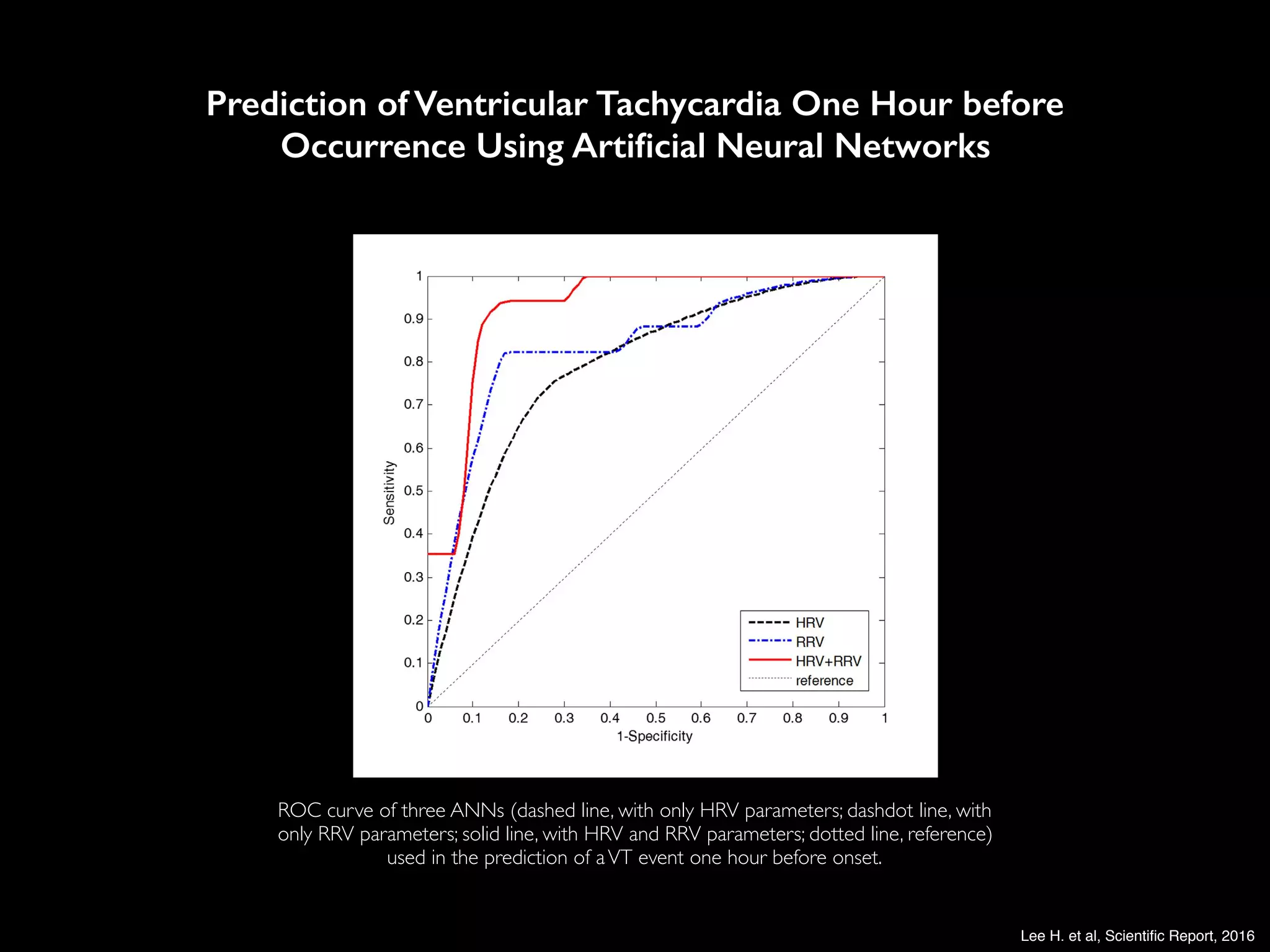 www.nature.com/scientificreports/
Discussion
Figure 1. ROC curve of three ANNs (dashed line, with only HRV parameters; dashdot line, with
parameters; solid line, with HRV and RRV parameters; dotted line, reference) used in the predict
VT event one hour before onset.
ROC curve of three ANNs (dashed line, with only HRV parameters; dashdot line, with
only RRV parameters; solid line, with HRV and RRV parameters; dotted line, reference)
used in the prediction of aVT event one hour before onset.
Prediction of Ventricular Tachycardia One Hour before 
Occurrence Using Artiﬁcial Neural Networks
Lee H. et al, Scientiﬁc Report, 2016
 