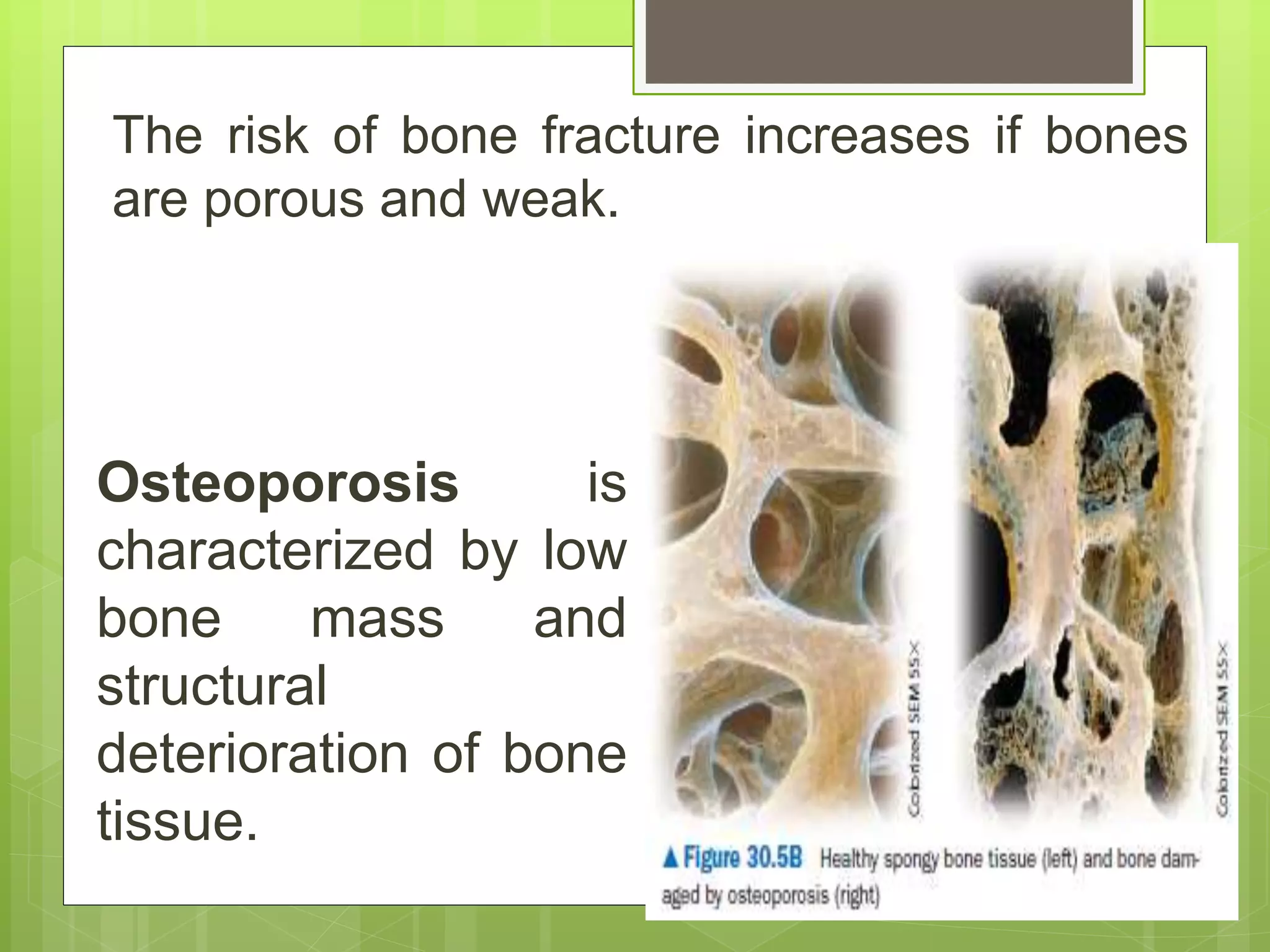 The risk of bone fracture increases if bones
are porous and weak.
Osteoporosis is
characterized by low
bone mass and
structural
deterioration of bone
tissue.
 