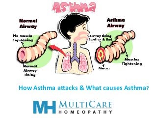 How Asthma attacks & What causes Asthma?
 