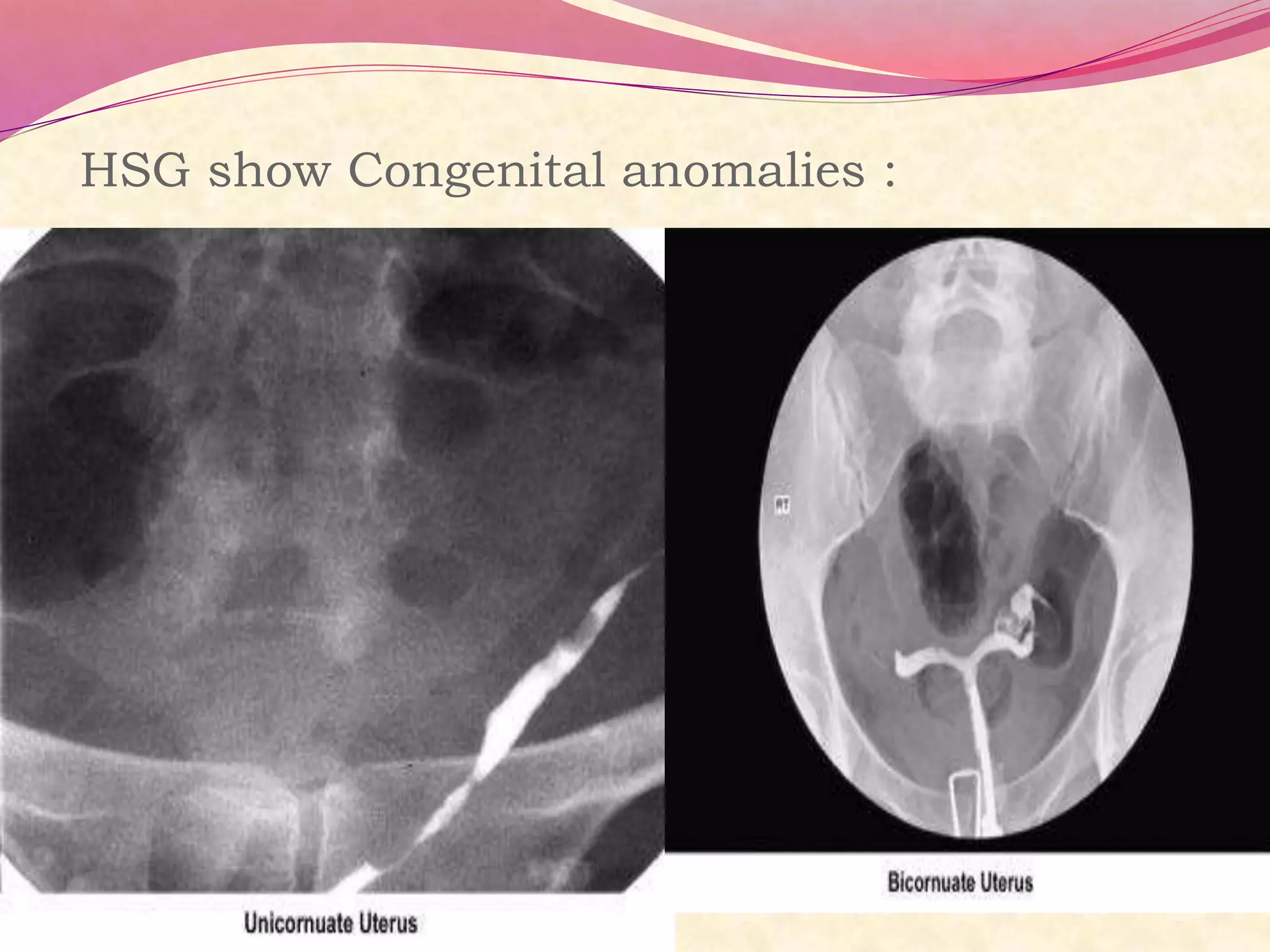 HSG show Congenital anomalies :
 