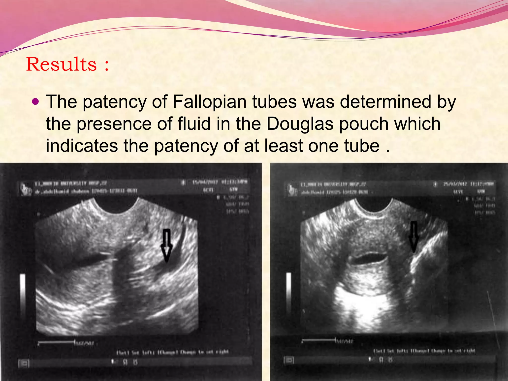 Results :
 The patency of Fallopian tubes was determined by
the presence of fluid in the Douglas pouch which
indicates the patency of at least one tube .
 