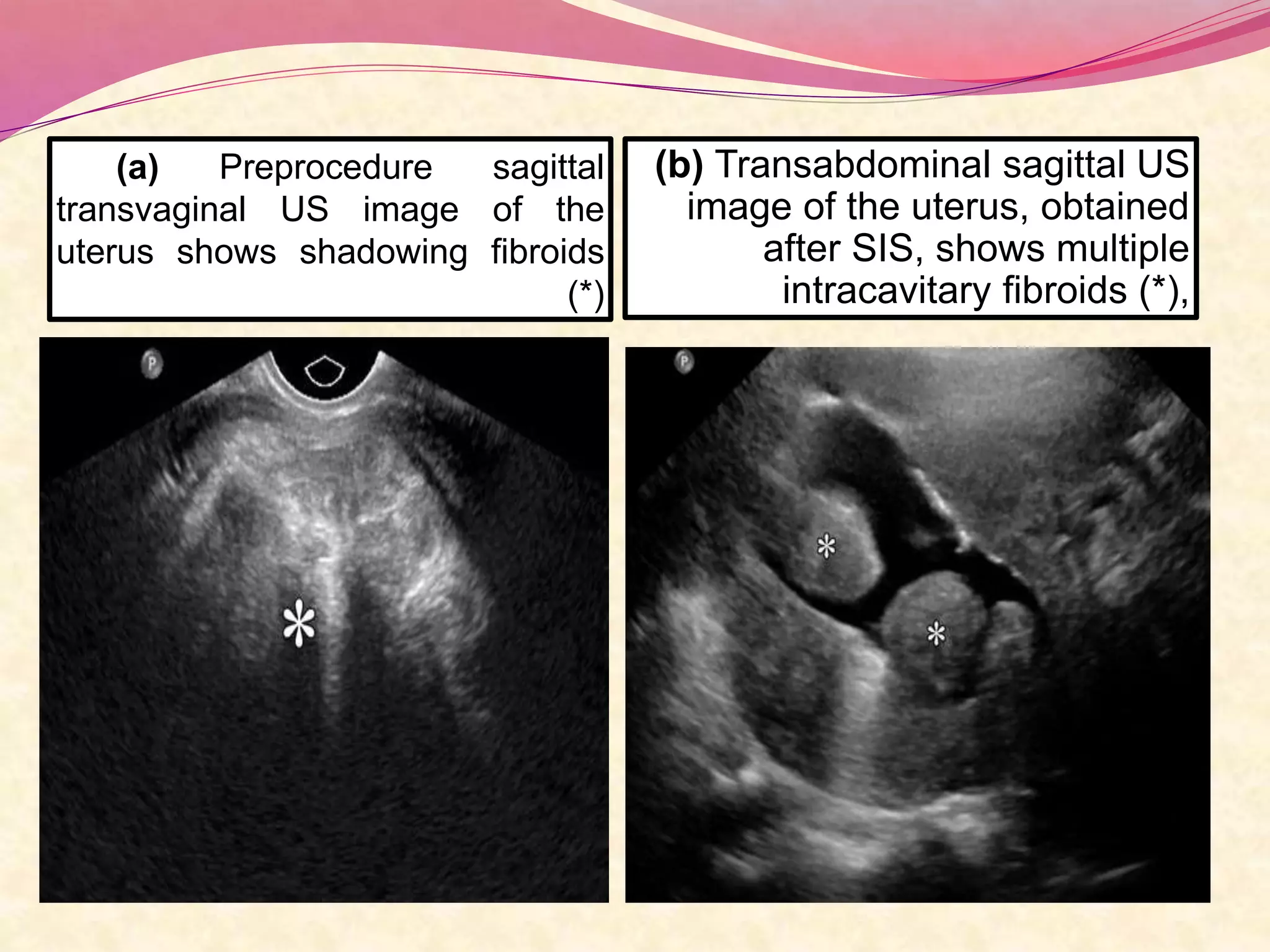 (a) Preprocedure sagittal
transvaginal US image of the
uterus shows shadowing fibroids
(*)
(b) Transabdominal sagittal US
image of the uterus, obtained
after SIS, shows multiple
intracavitary fibroids (*),
 