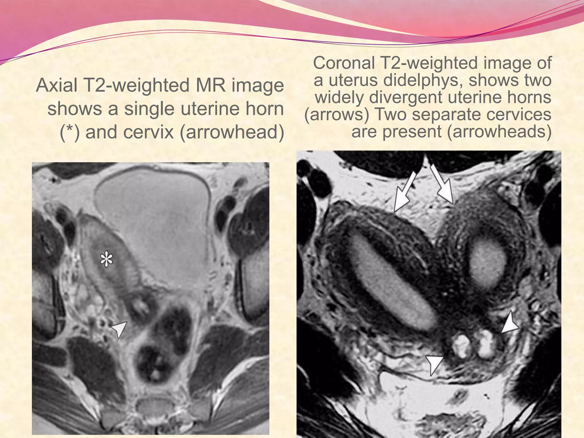 Axial T2-weighted MR image
shows a single uterine horn
(*) and cervix (arrowhead)
Coronal T2-weighted image of
a uterus didelphys, shows two
widely divergent uterine horns
(arrows) Two separate cervices
are present (arrowheads)
 