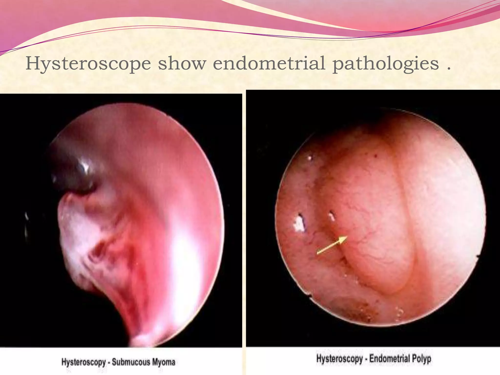 Hysteroscope show endometrial pathologies .
 