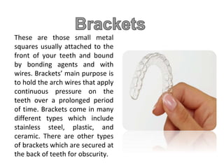 These are those small metal
squares usually attached to the
front of your teeth and bound
by bonding agents and with
wires. Brackets’ main purpose is
to hold the arch wires that apply
continuous pressure on the
teeth over a prolonged period
of time. Brackets come in many
different types which include
stainless steel, plastic, and
ceramic. There are other types
of brackets which are secured at
the back of teeth for obscurity.
 
