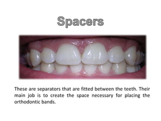 These are separators that are fitted between the teeth. Their
main job is to create the space necessary for placing the
orthodontic bands.
 
