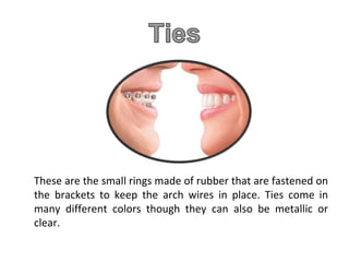 These are the small rings made of rubber that are fastened on
the brackets to keep the arch wires in place. Ties come in
many different colors though they can also be metallic or
clear.
 