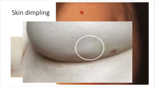 How breast aware are you | PDF
