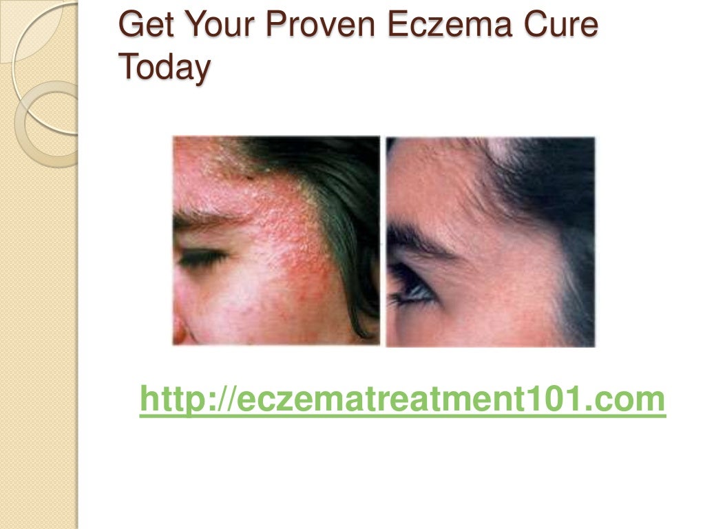 How can i stop my eczema from itching