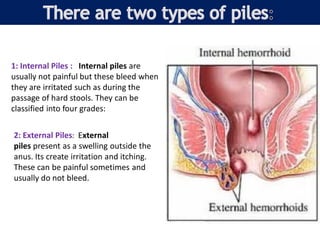 1: Internal Piles : Internal piles are
usually not painful but these bleed when
they are irritated such as during the
passage of hard stools. They can be
classified into four grades:
2: External Piles: External
piles present as a swelling outside the
anus. Its create irritation and itching.
These can be painful sometimes and
usually do not bleed.
 