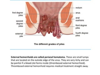 External hemorrhoids are called perianal hematoma. These are small lumps
that are located on the outside edge of the anus. They are very itchy and can
be painful if a blood clot forms inside (thrombosed external hemorrhoid).
Thrombosed external hemorrhoid requires medical treatment straight away.
 