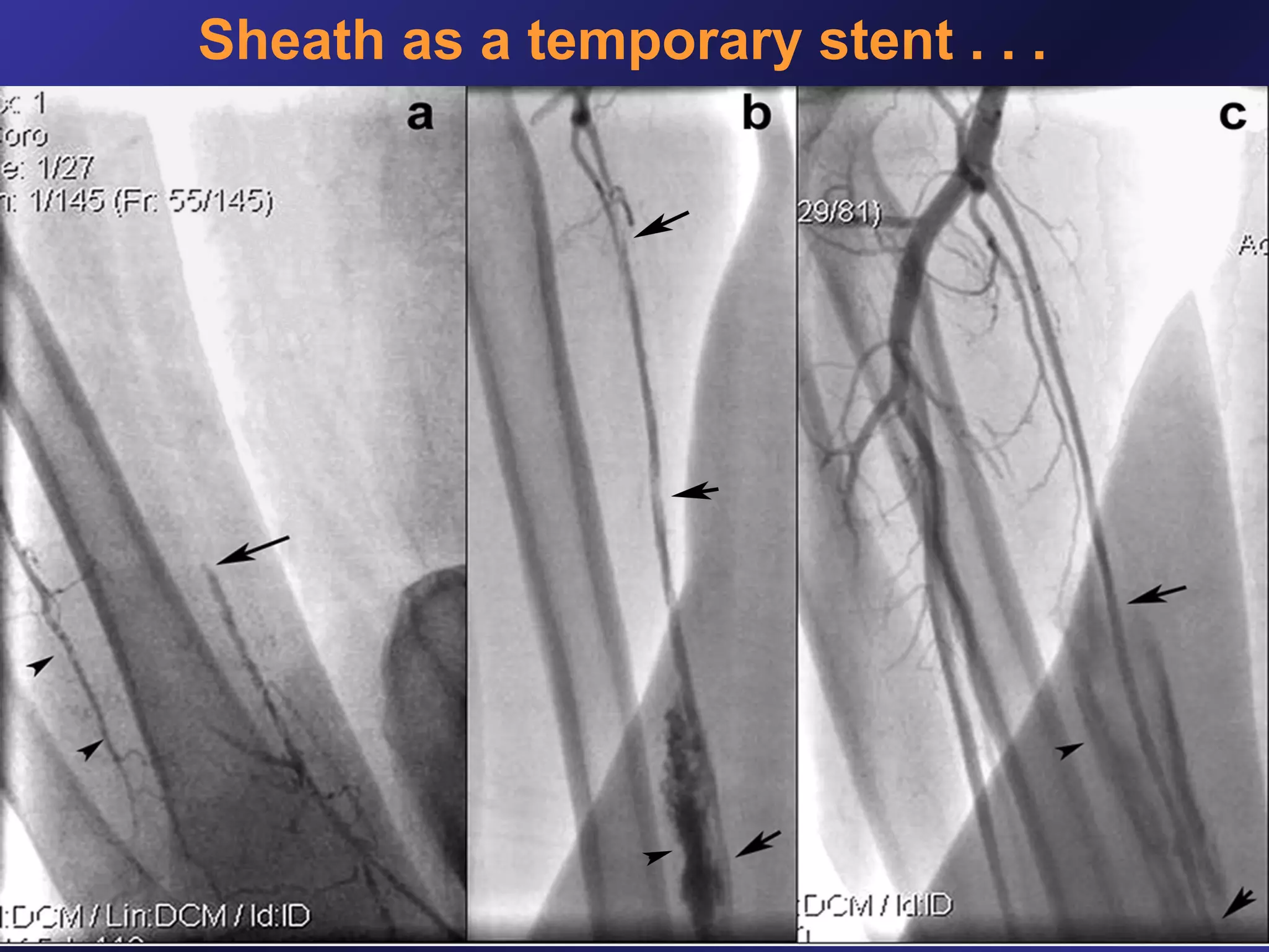 Sheath as a temporary stent . . .

 