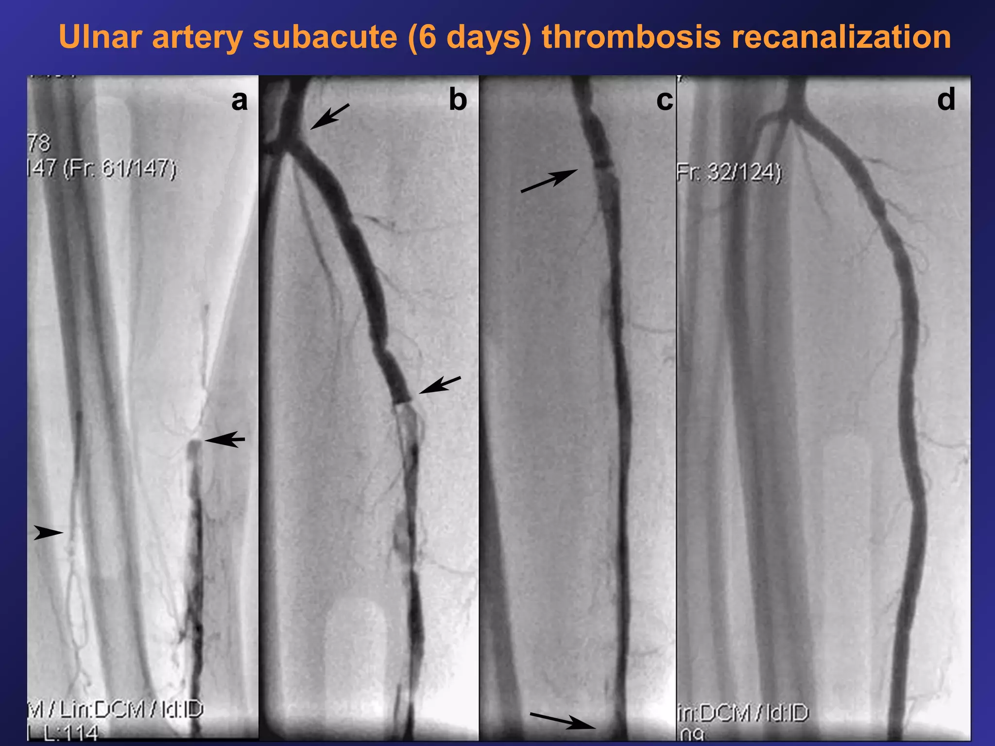 Ulnar artery subacute (6 days) thrombosis recanalization

 