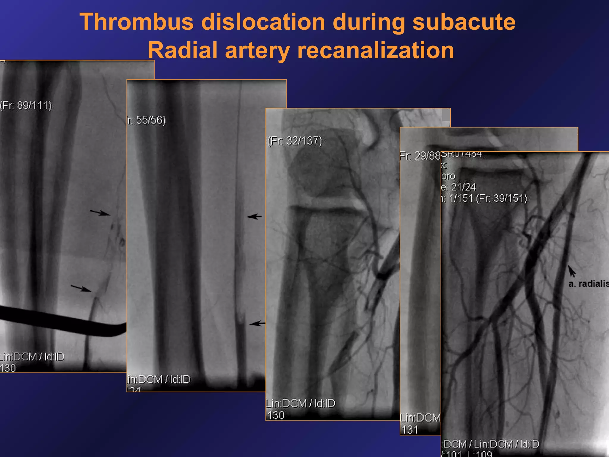 Thrombus dislocation during subacute
Radial artery recanalization

 