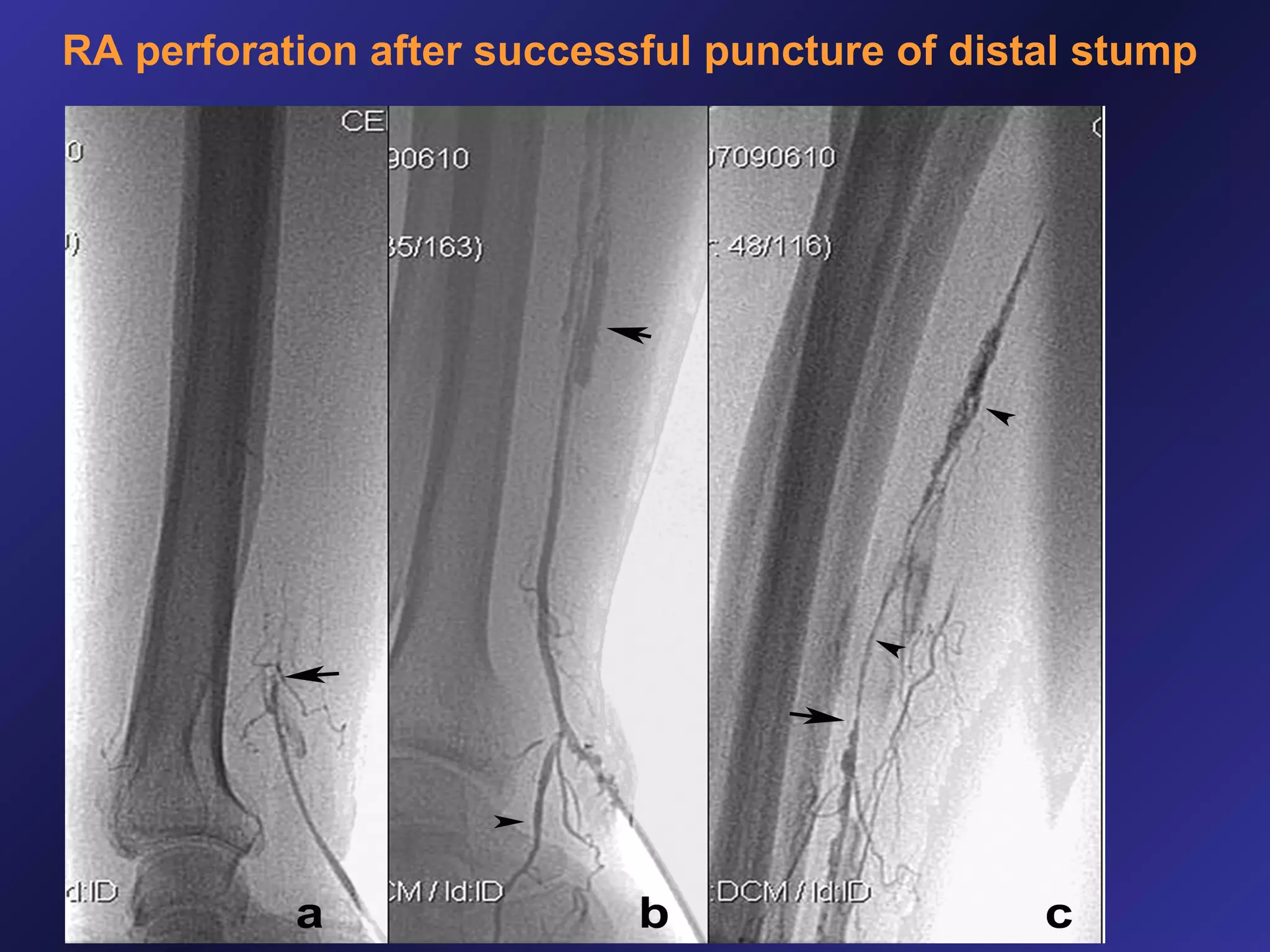 RA perforation after successful puncture of distal stump

 