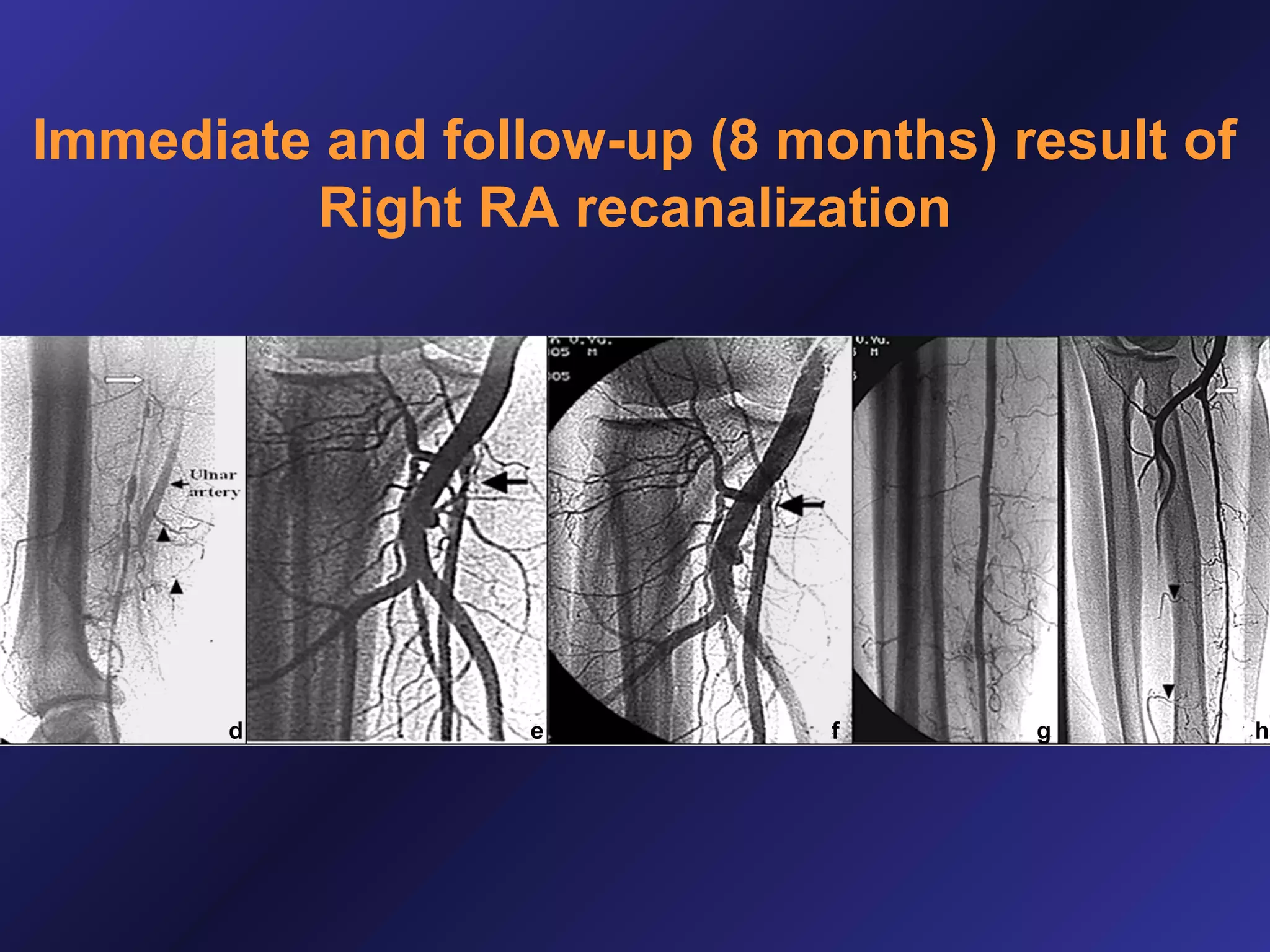Immediate and follow-up (8 months) result of
Right RA recanalization

 