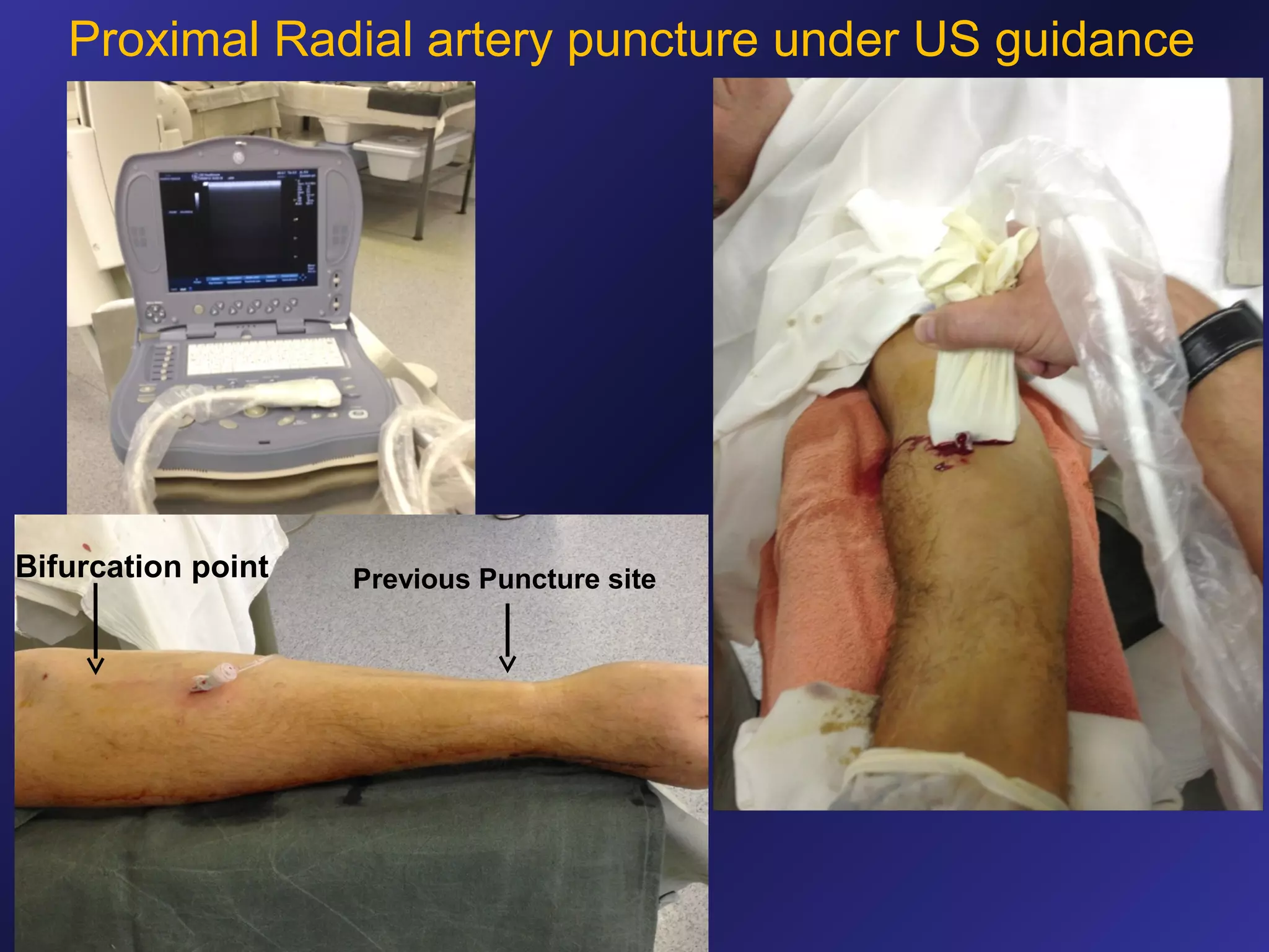Proximal Radial artery puncture under US guidance

Bifurcation point

Previous Puncture site

 