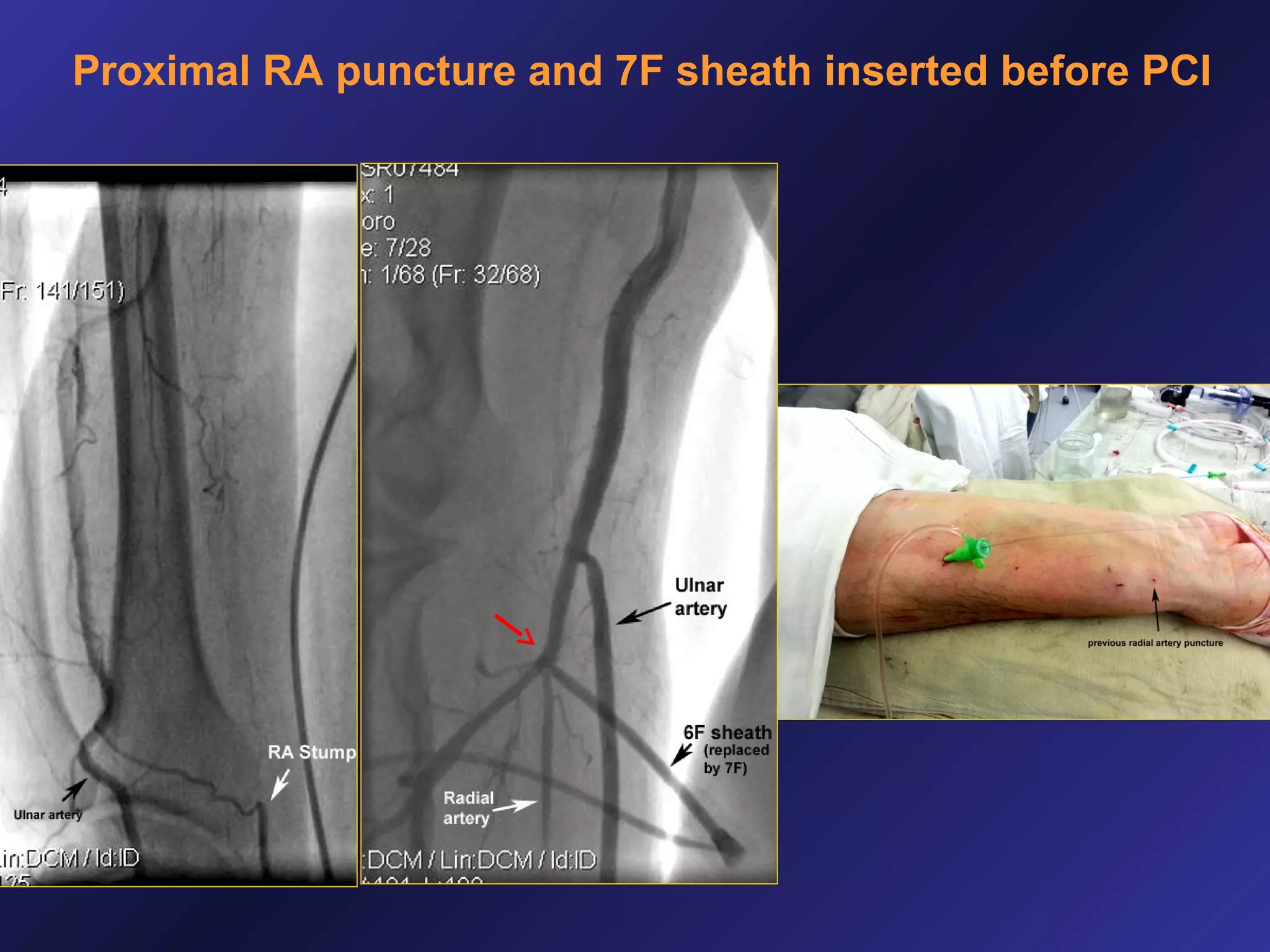 Proximal RA puncture and 7F sheath inserted before PCI

 