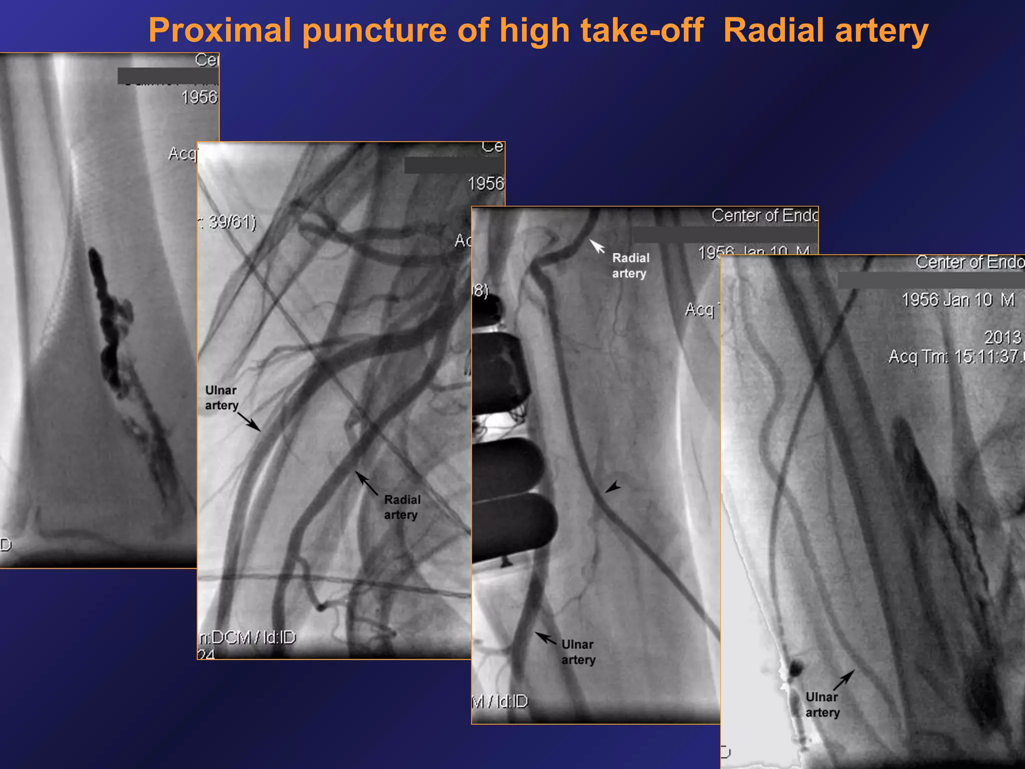 Proximal puncture of high take-off Radial artery

 