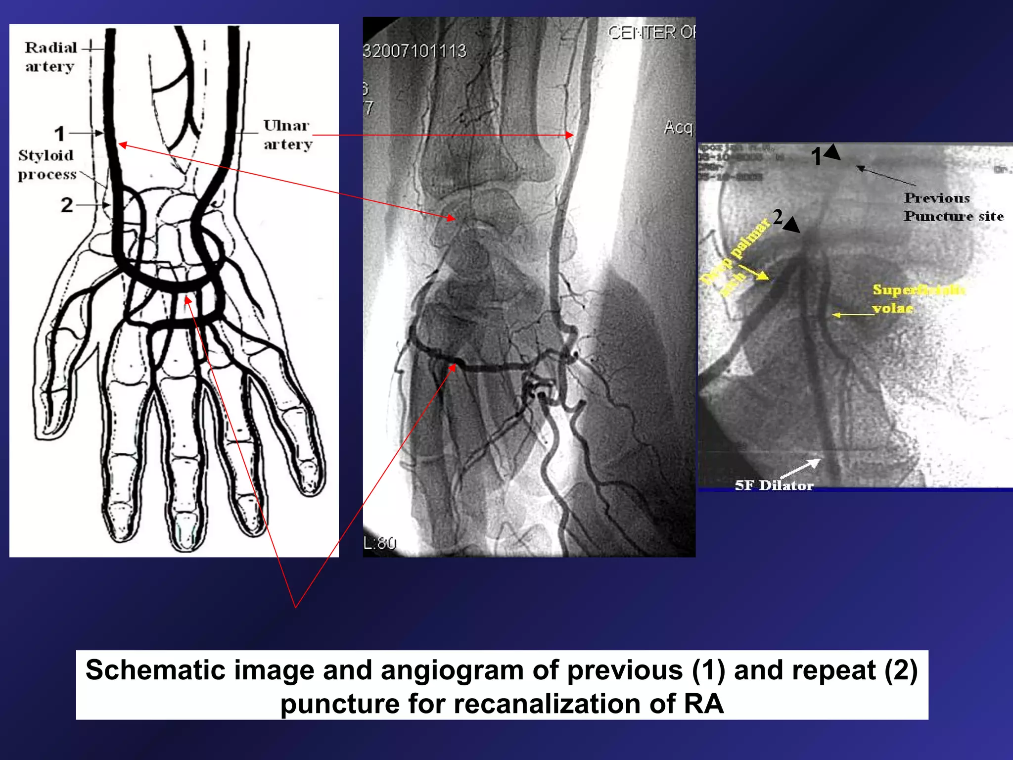 1
2

Schematic image and angiogram of previous (1) and repeat (2)
puncture for recanalization of RA

 