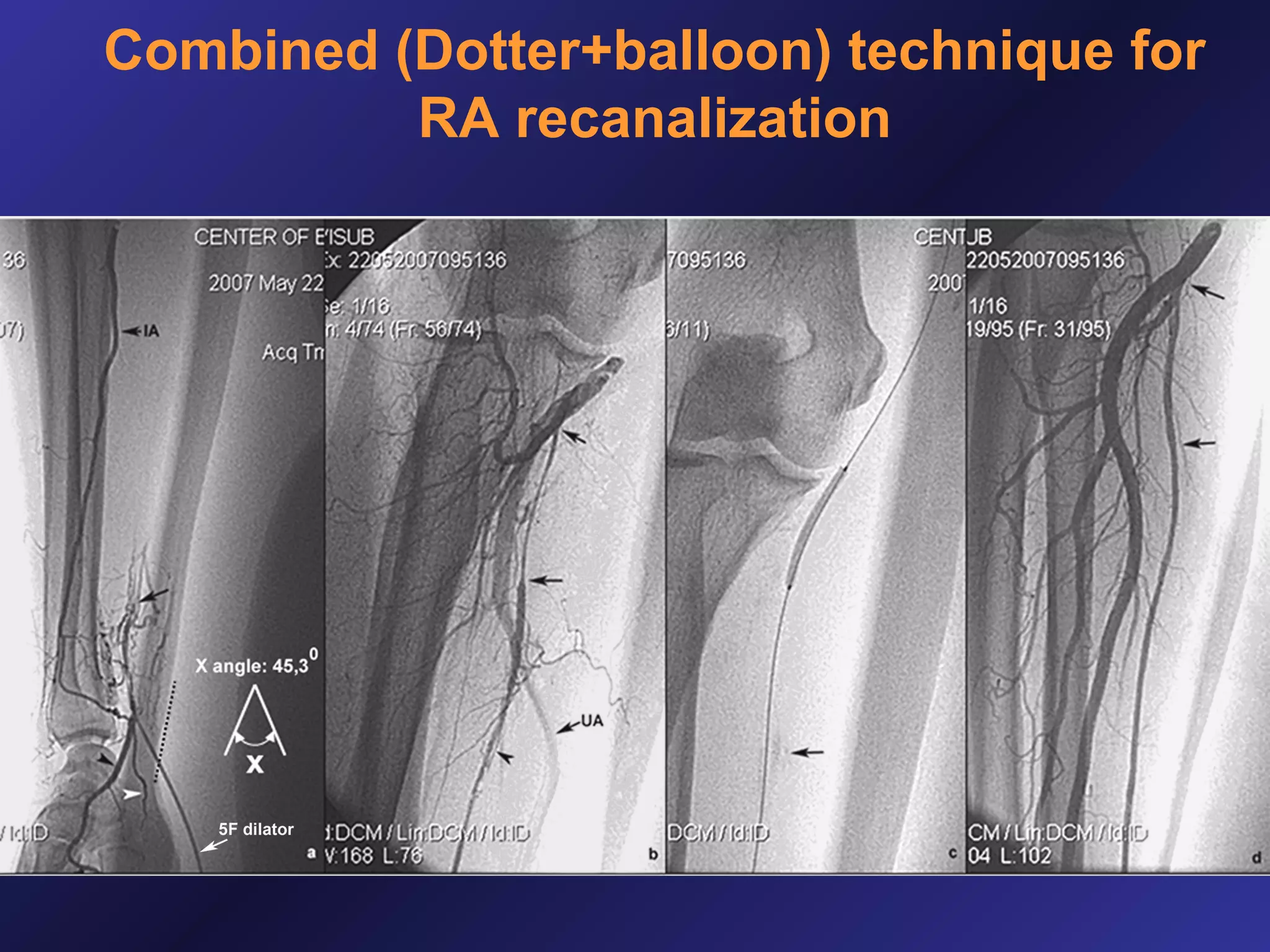 Combined (Dotter+balloon) technique for
RA recanalization

 