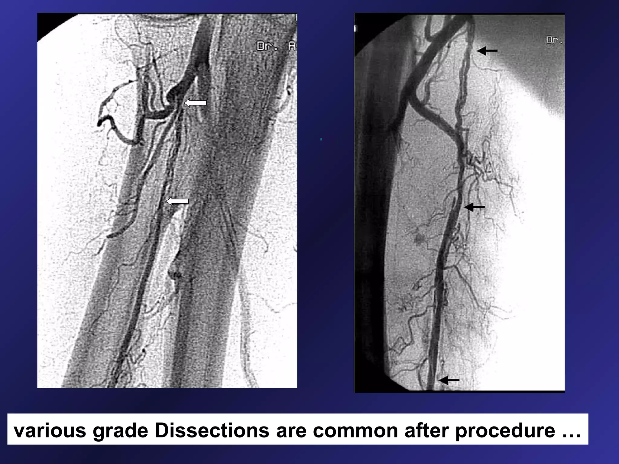 various grade Dissections are common after procedure …

 