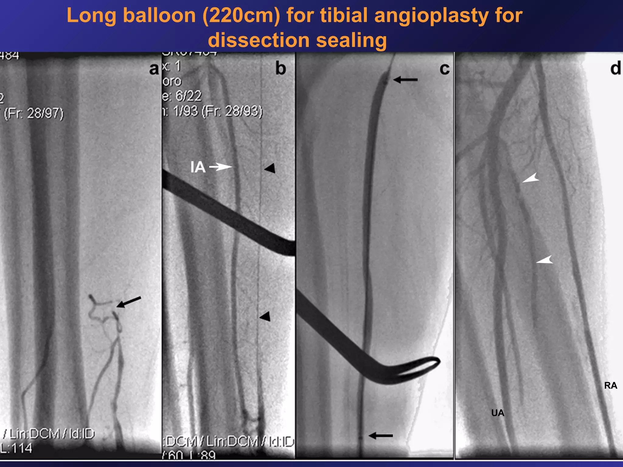 Long balloon (220cm) for tibial angioplasty for
dissection sealing

 