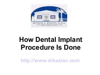 How Dental Implant
Procedure Is Done
http://www.drkezian.com
 