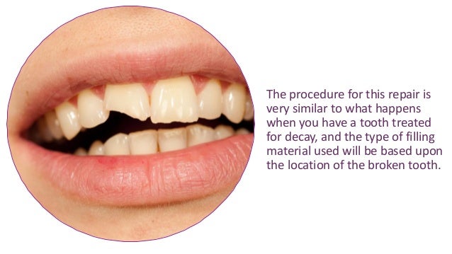 How to fix a broken tooth yourself fast How to fix a broken tooth yourself fast