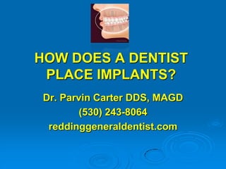 HOW DOES A DENTIST
PLACE IMPLANTS?
Dr. Parvin Carter DDS, MAGD
(530) 243-8064
reddinggeneraldentist.com

 