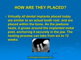HOW ARE THEY PLACED?


Virtually all dental implants placed today
are similar to an actual tooth root and are
placed within the bone. As the jawbone
heals, it grows around the implanted metal
post, anchoring it securely in the jaw. The
healing process can take from six to 12
weeks.

reddinggeneraldentist.com

 