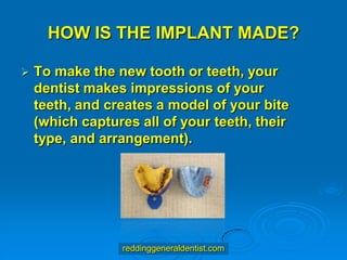 HOW IS THE IMPLANT MADE?


To make the new tooth or teeth, your
dentist makes impressions of your
teeth, and creates a model of your bite
(which captures all of your teeth, their
type, and arrangement).

reddinggeneraldentist.com

 