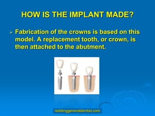 HOW IS THE IMPLANT MADE?


Fabrication of the crowns is based on this
model. A replacement tooth, or crown, is
then attached to the abutment.

reddinggeneraldentist.com

 