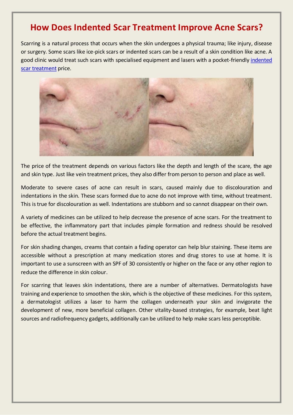 How does indented scar treatment improve acne scars