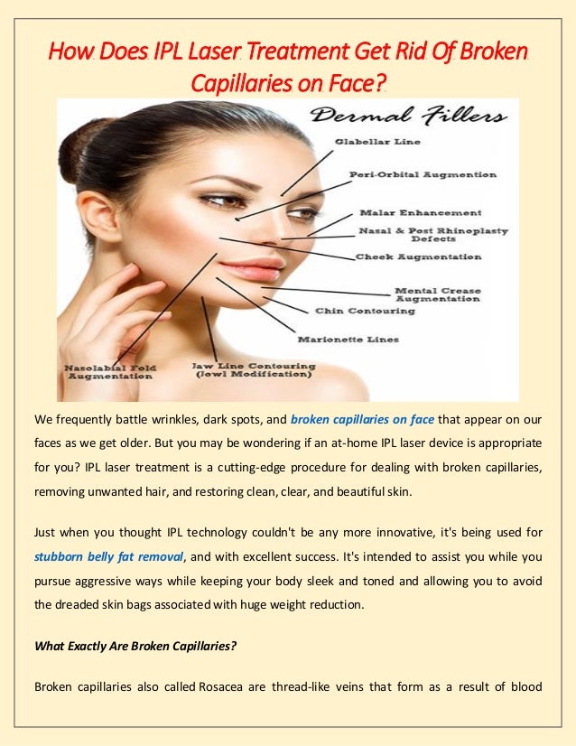 How Does IPL Laser Treatment Get Rid Of Broken Capillaries on Face.pdf