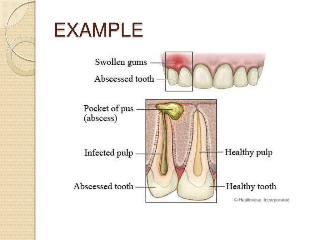 How does pus spread inside the tissue