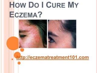 HOW DO I CURE MY
ECZEMA?




 http://eczematreatment101.com
 
