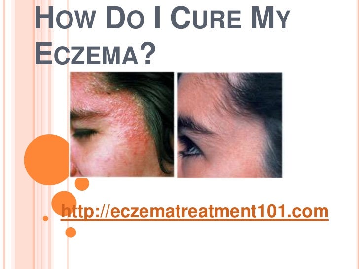 How do i cure my eczema