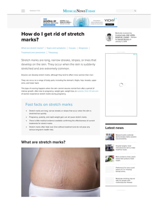 How do I get rid of stretch
marks?
Stretch marks are long, narrow streaks, stripes, or lines that
develop on the skin. They occur when the skin is suddenly
stretched and are extremely common.
Anyone can develop stretch marks, although they tend to affect more women than men.
They can occur on a range of body parts, including the stomach, thighs, hips, breasts, upper
arms, and lower back.
This type of scarring happens when the skin cannot resume normal form after a period of
intense growth, often due to pregnancy, weight gain, weight loss, or puberty. Over 50 percent
of women experience stretch marks during pregnancy.
Fast facts on stretch marks
Stretch marks are long, narrow streaks or stripes that occur when the skin is
stretched too quickly.
Pregnancy, puberty, and rapid weight gain can all cause stretch marks.
There is little medical evidence available confirming the effectiveness of current
treatments for stretch marks.
Stretch marks often fade over time without treatment and do not pose any
serious long-term health risks.
What are stretch marks? Signs and symptoms Causes Diagnosis
Treatment and prevention Takeaway
What are stretch marks?
Medically reviewed by
Cynthia Cobb, DNP, APRN,
WHNP-BC, FAANP — Written
by Hannah Nichols on
January 5, 2018
Massachusetts outbreak
demonstrates Delta variant's
transmissibility
Despite targets, food
manufacturers fail to make
healthier foods
More evidence that a plant-
based diet protects heart
health
Preference for sons could
lead to 4.7 m ‘missing’
female births
Moderate drinking may be
safe for people with
cardiovascular disease
ADVERTISEMENT
Latest news
ADVERTISEMENT
ADVERTISEMENT
NEWSLETTER
 