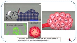 Y neumonía , generalmente bacteriana , así como el SARS CoV2,
ataca afectando la funcionalidad de los alveólos.
 