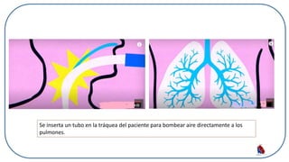 Se inserta un tubo en la tráquea del paciente para bombear aire directamente a los
pulmones.
 
